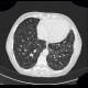 Sarcoidosis, pulmonary sarcoidosis, stage IV: CT - Computed tomography